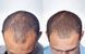 TRX2 Hair Growth Complex - Молекулярний комплекс проти випадіння волосся OXFORD BIOLABS, 1 банка * 90 капсул (1 місяць)