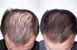 TRX2 Hair Growth Complex - Молекулярний комплекс проти випадіння волосся OXFORD BIOLABS, 1 банка * 90 капсул (1 місяць)